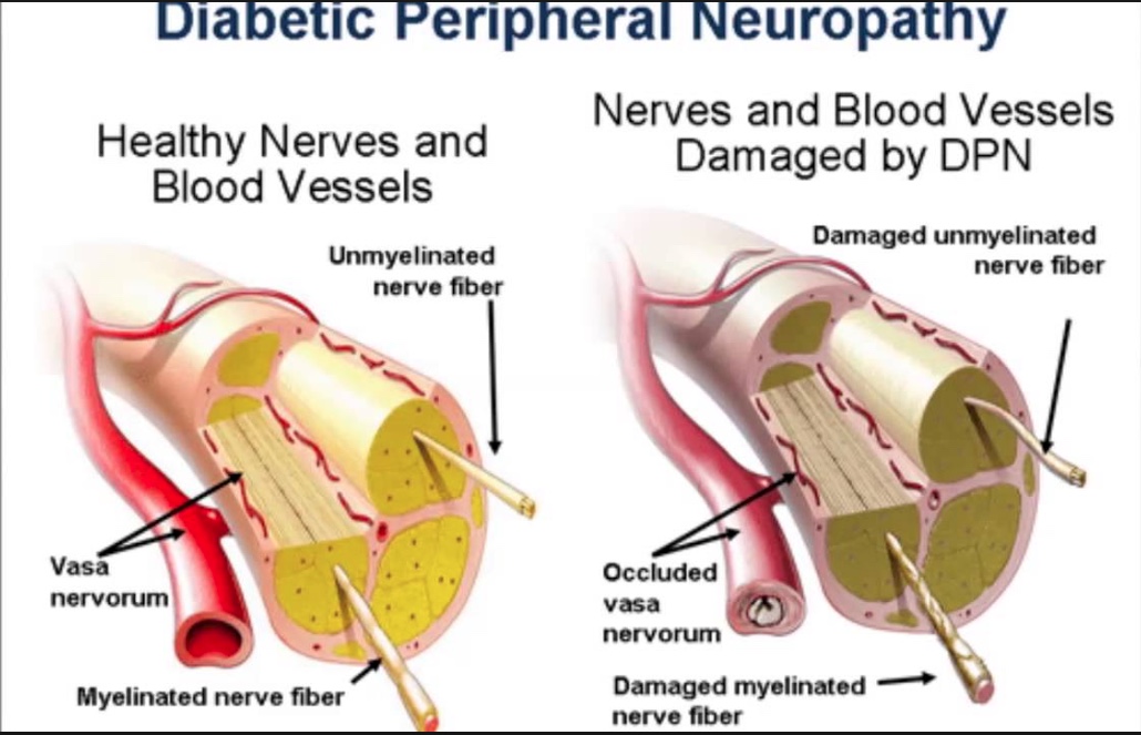 ECP benifits in Diabetic Neuropathy