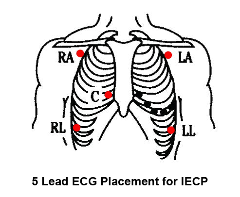 ECG Electrode placement in ECP