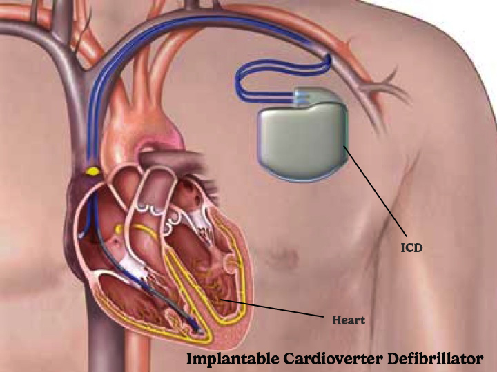 ICD in heart failure